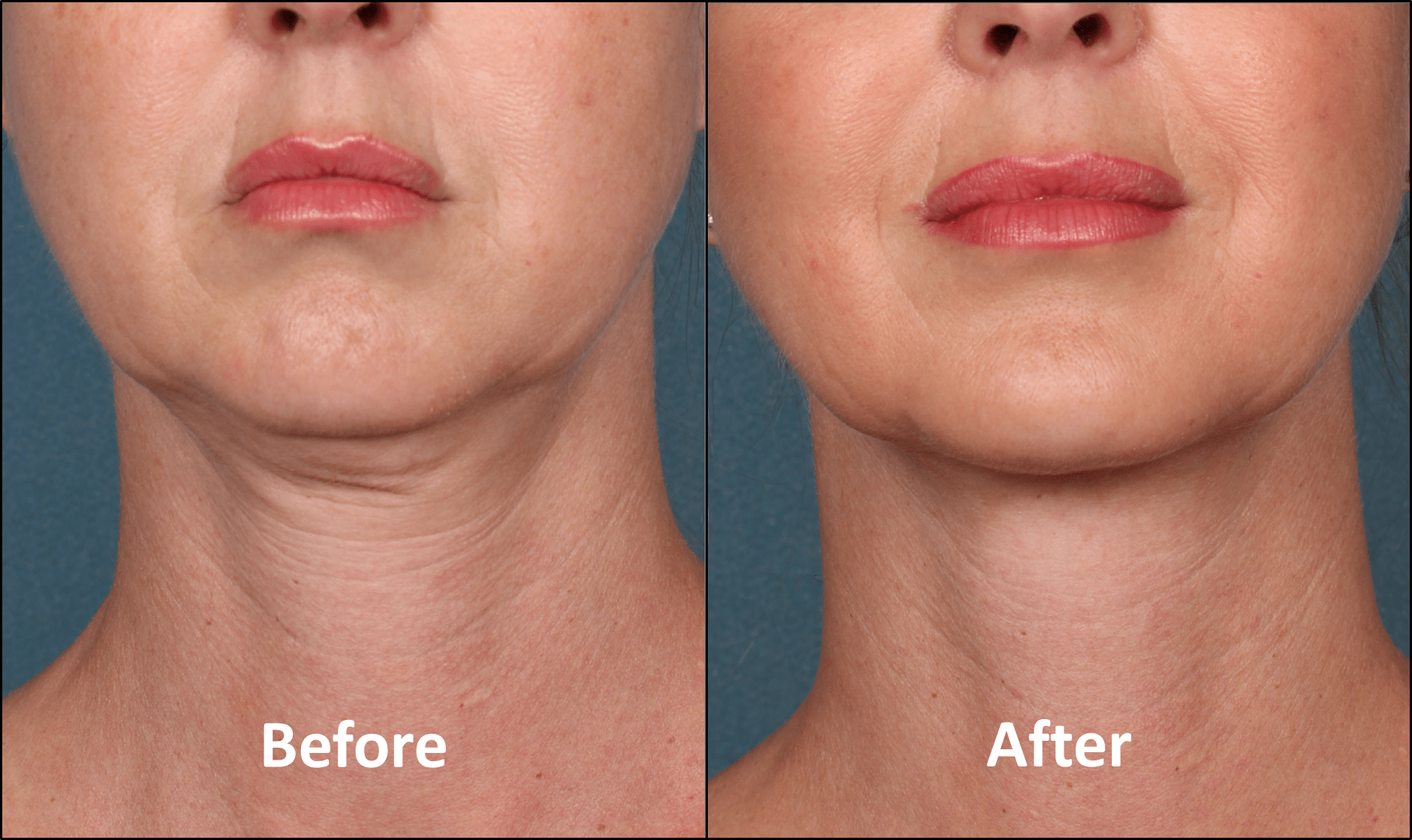 Kybella patient before and after front view bay pointe dermatology
