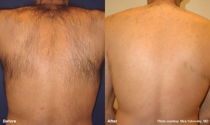 Laser Hair Removal in Miami, FL by Dr. Lima-Maribona